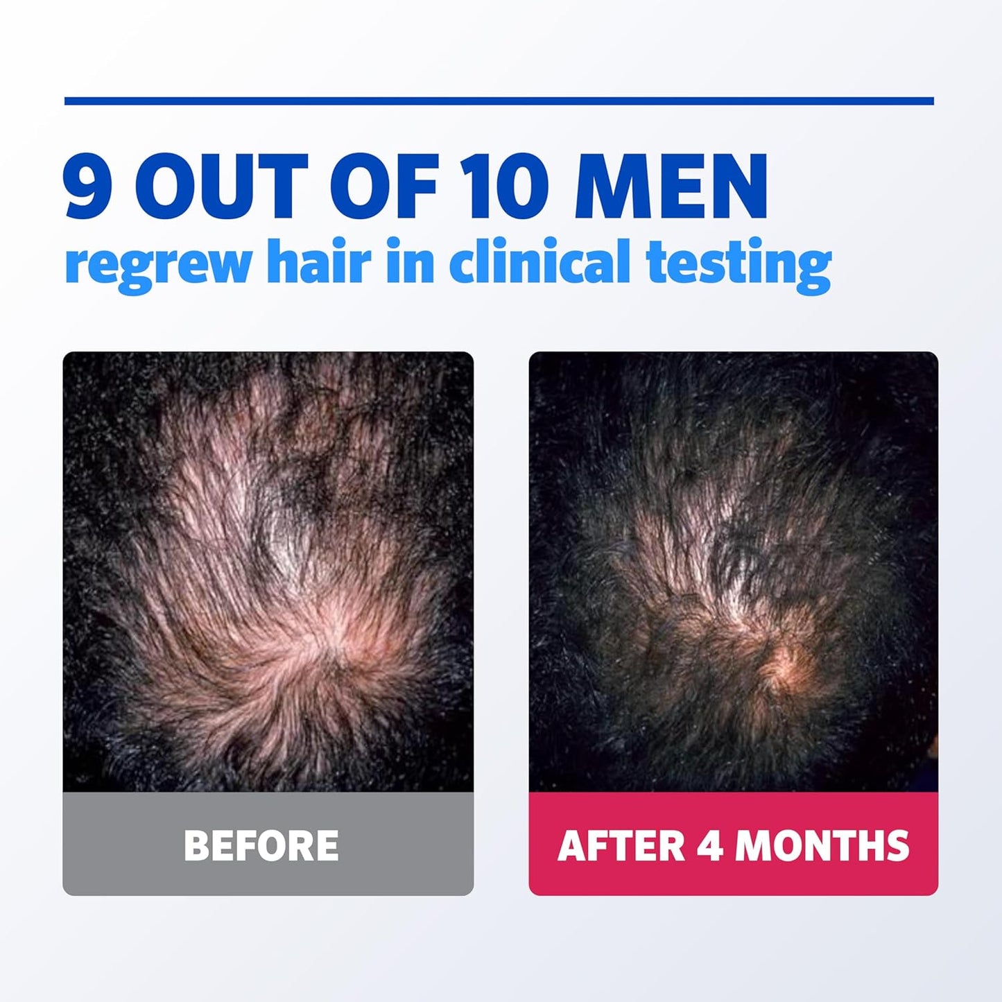 3 months Men's Rogaine Foam 5% Minoxidil